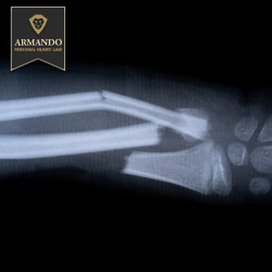 X-ray showing a wrist fracture as a result of an accident in Brandon
