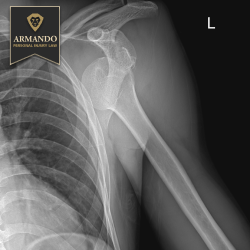 After an accident in Riverview, the x-ray of the personal injury victim's left shoulder