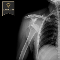 X-ray showing an injured shoulder with visible bone displacement, following an accident in Dunedin