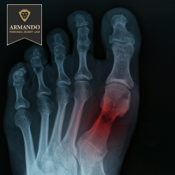The X-ray of a fractured foot following a Tarpon Springs accident