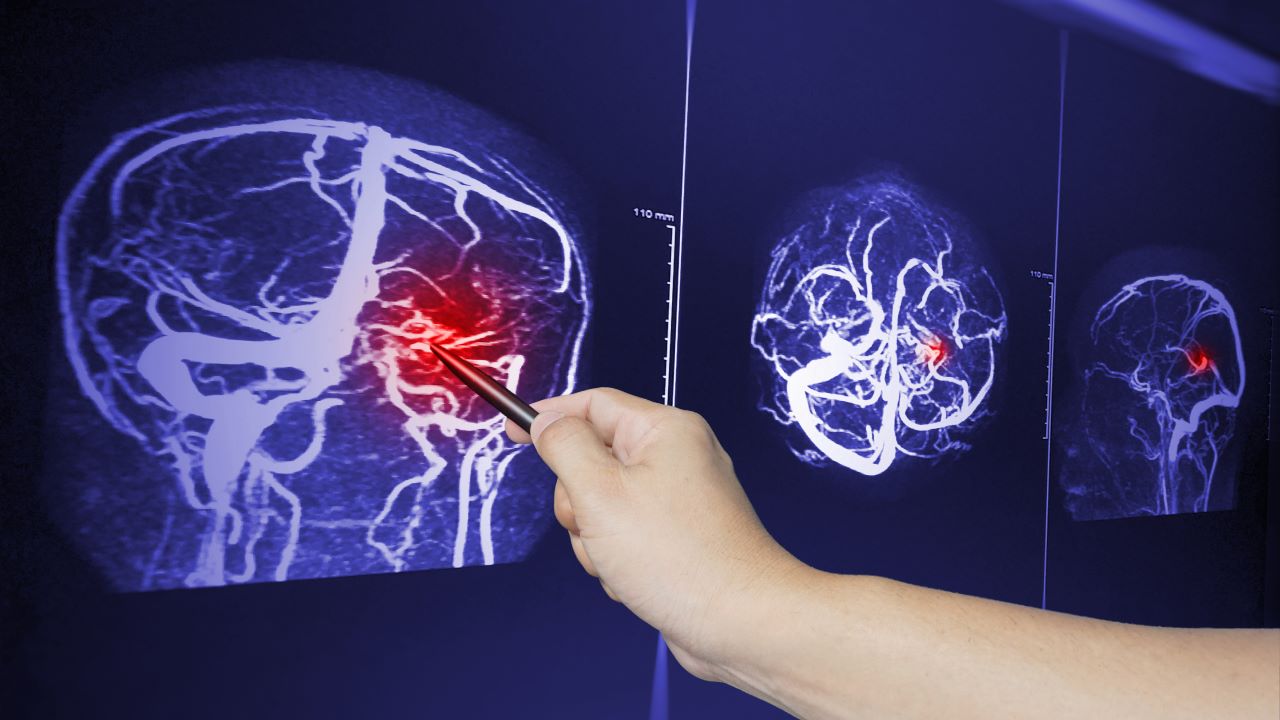 Brain scan showing trauma after auto collision.